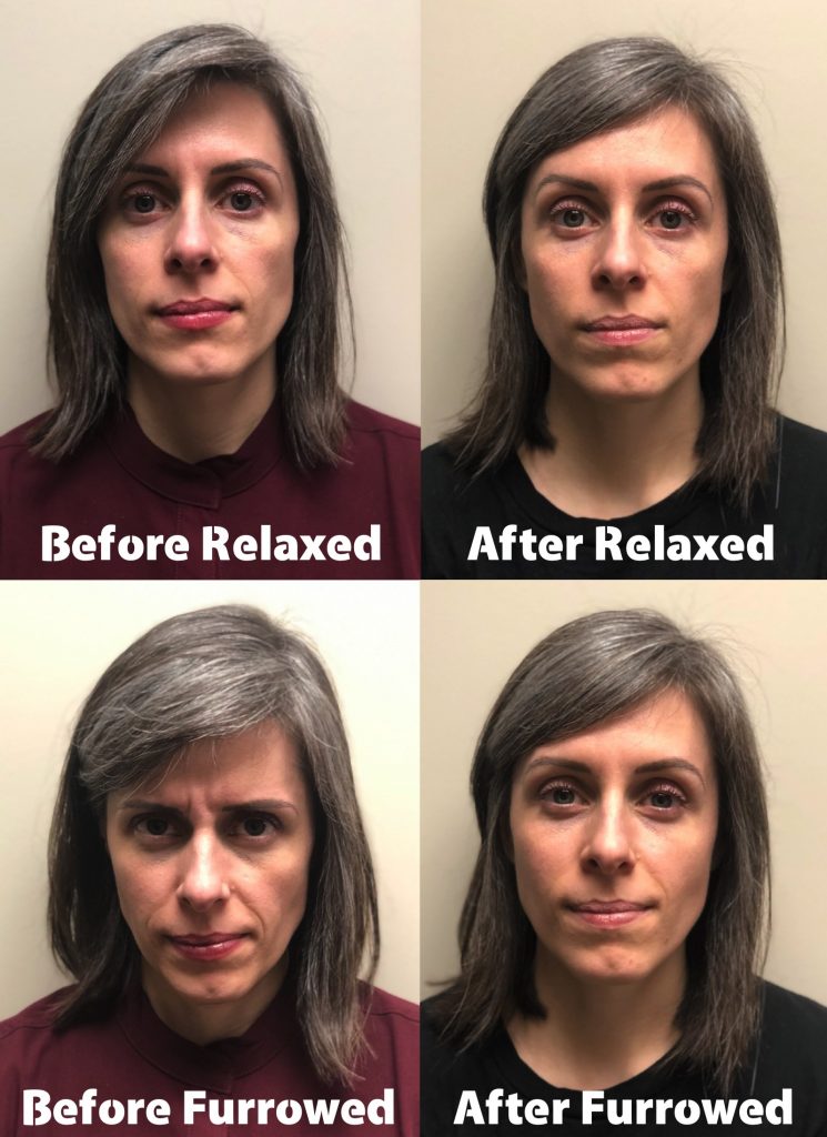 Botox glabellar lines before and after