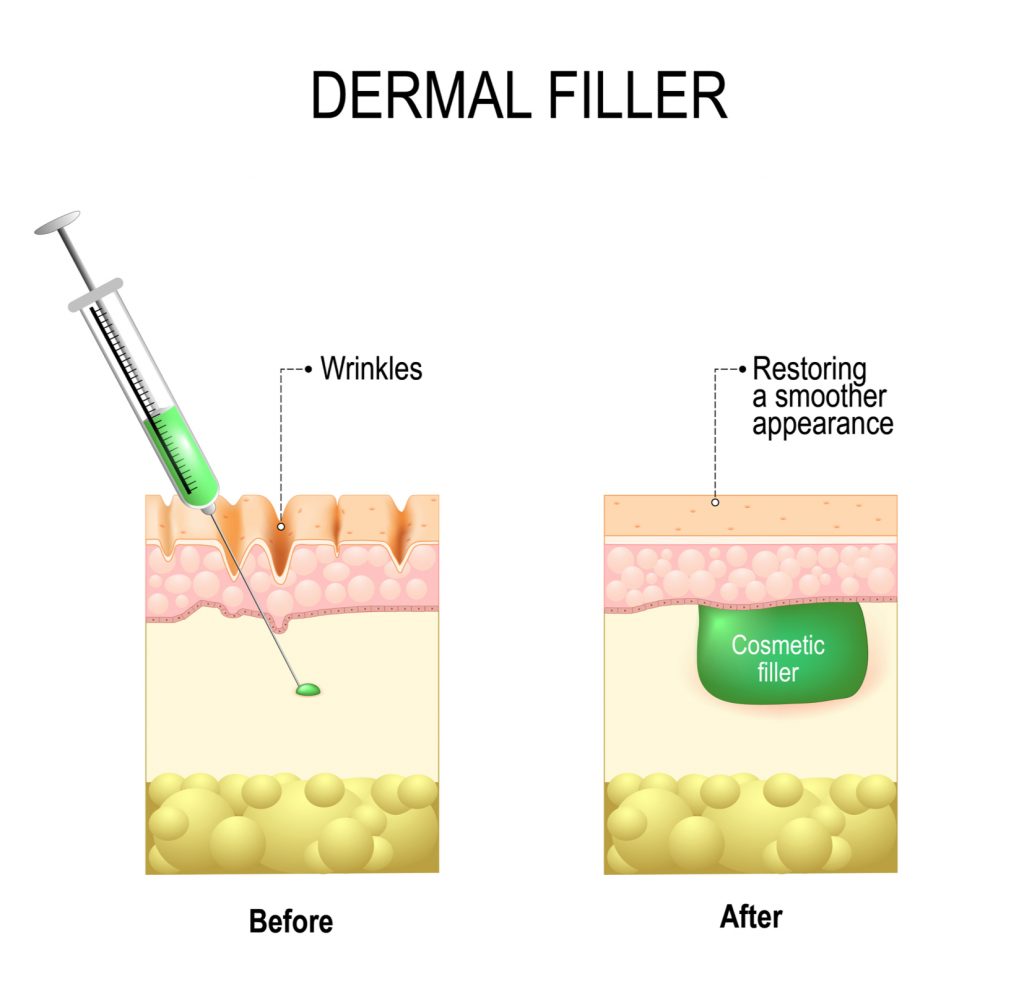 dermal fillers treating wrinkles