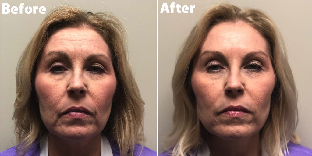 Botox and fillers before and after