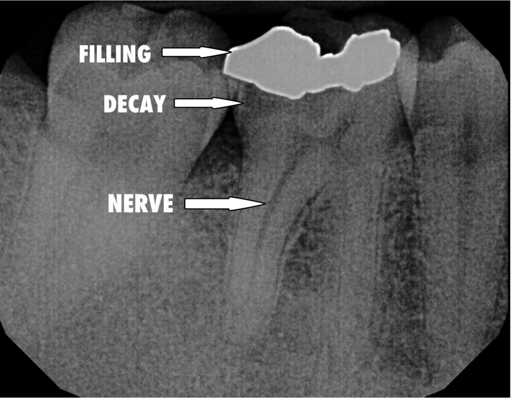 tooth with deep decay needing root canal therapy