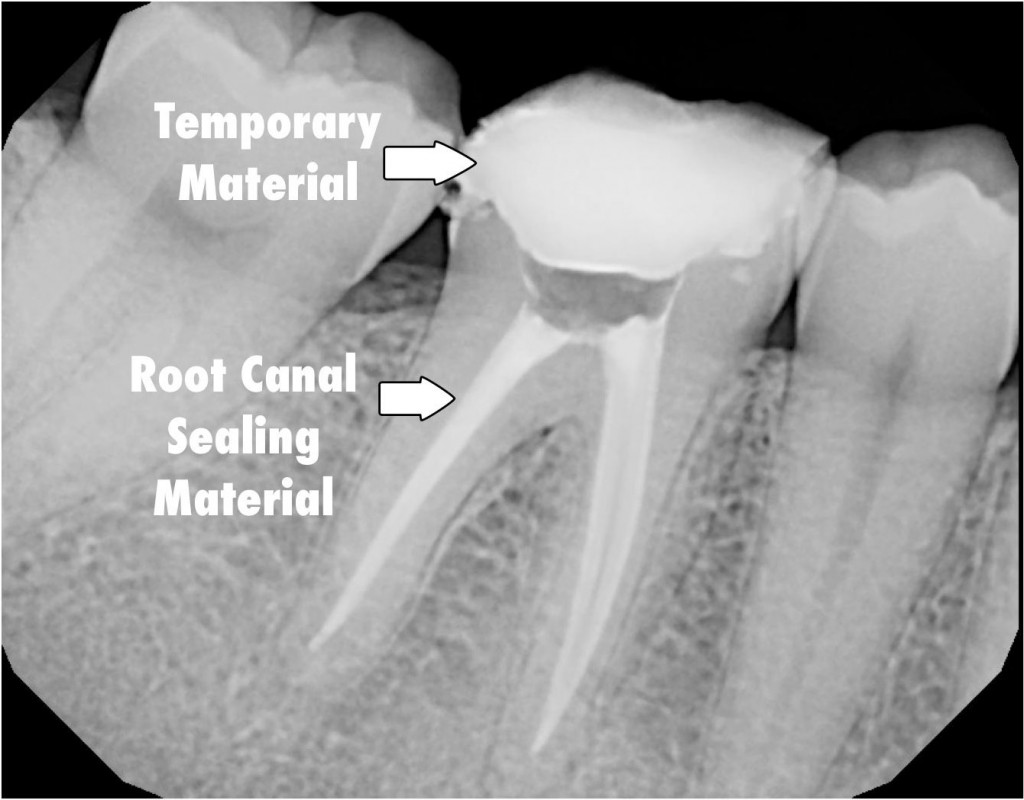 tooth with root canal therapy completed dentist near me