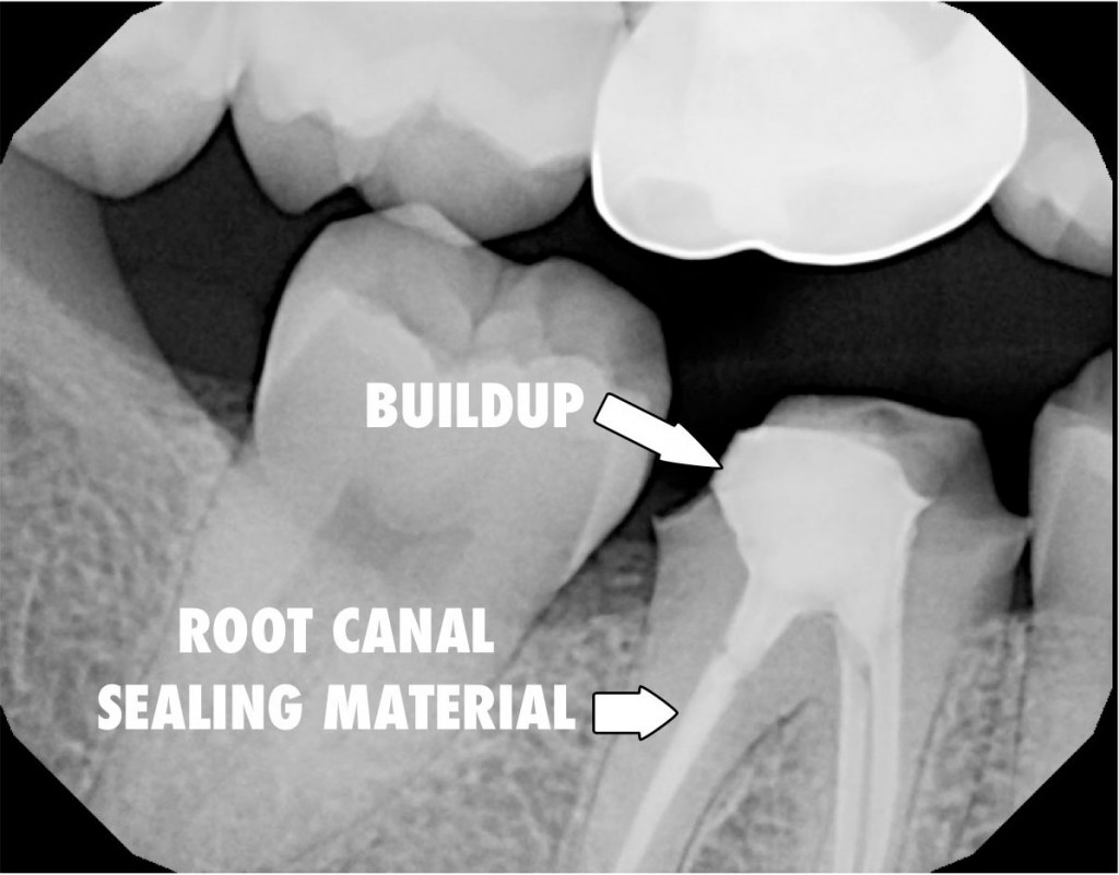 Birmingham dentist tooth with root canal and buildup completed