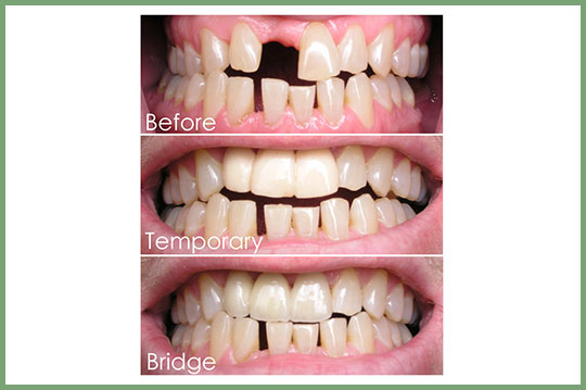 Dental bridge before/interim/after