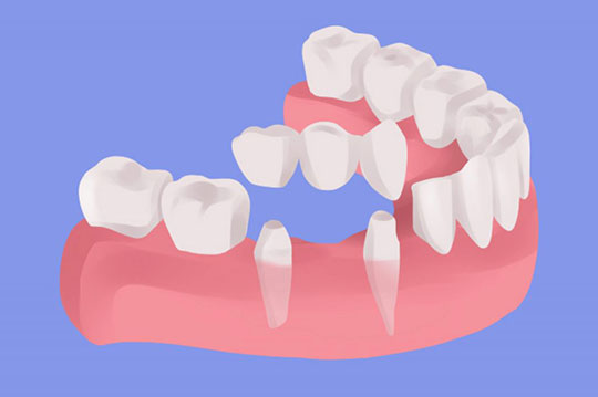 youtube video explaining dental bridges