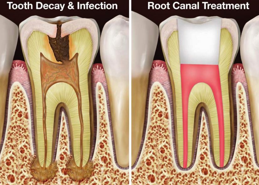 Root Canal Therapy Description