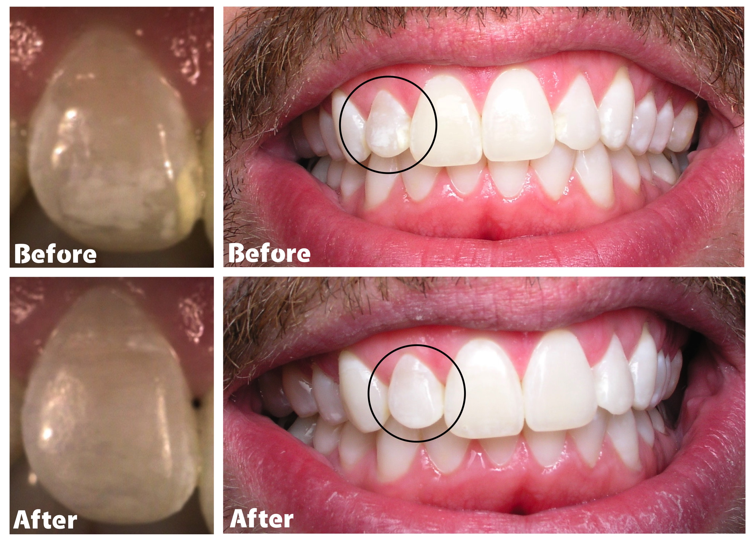 What Are White Spots On Teeth And What Can You Do About Them Advance