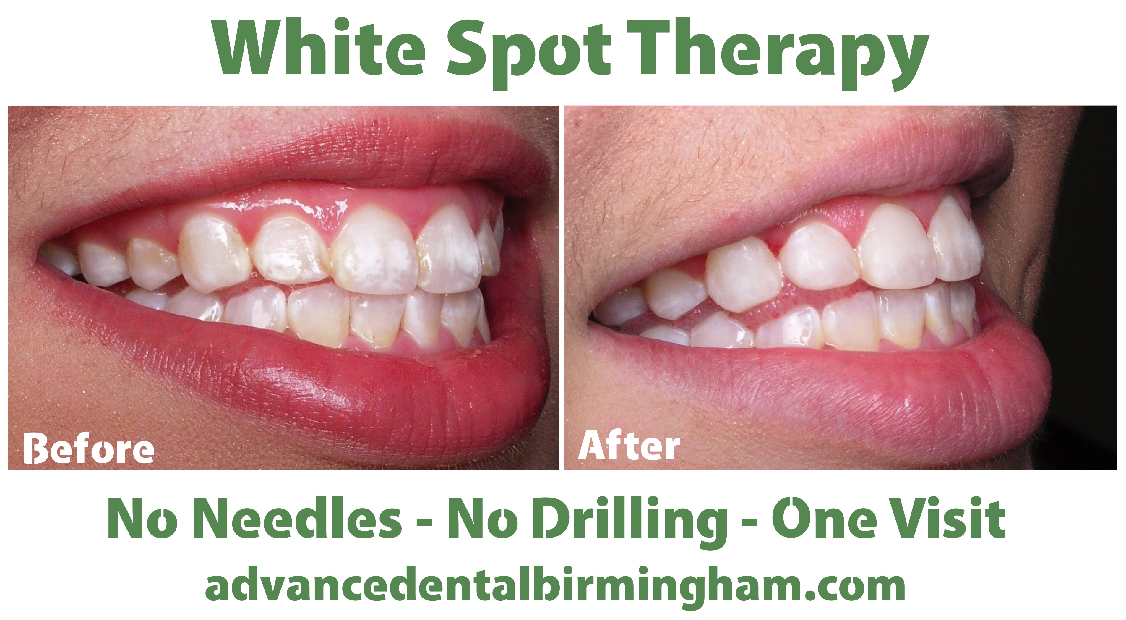 how-to-get-rid-of-white-spots-on-teeth-tablepossible