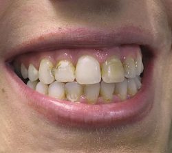 Teeth enhanced with fillings and crowns (before)