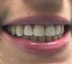 Teeth fixed with fillings and crowns (after)