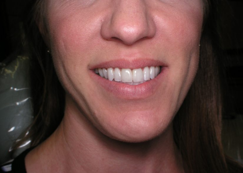 Front teeth fixed with crowns (after)
