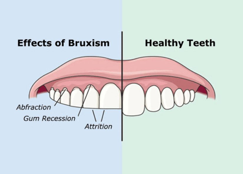 Effects of bruxism (grinding) graphic