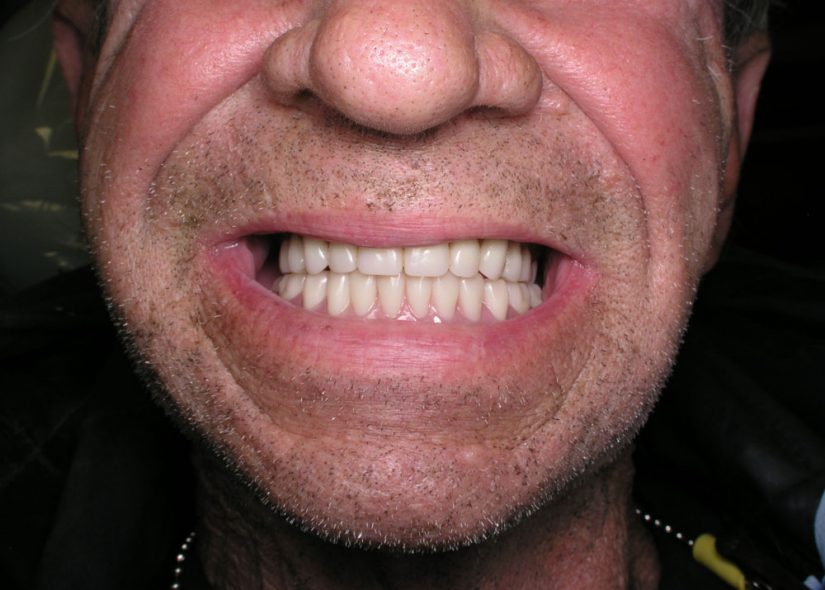 Smile with dentures in place