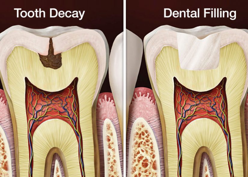 Tooth decay/dental filling graphic
