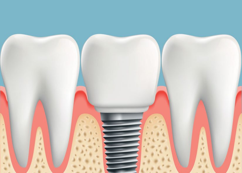 Implant with crown example