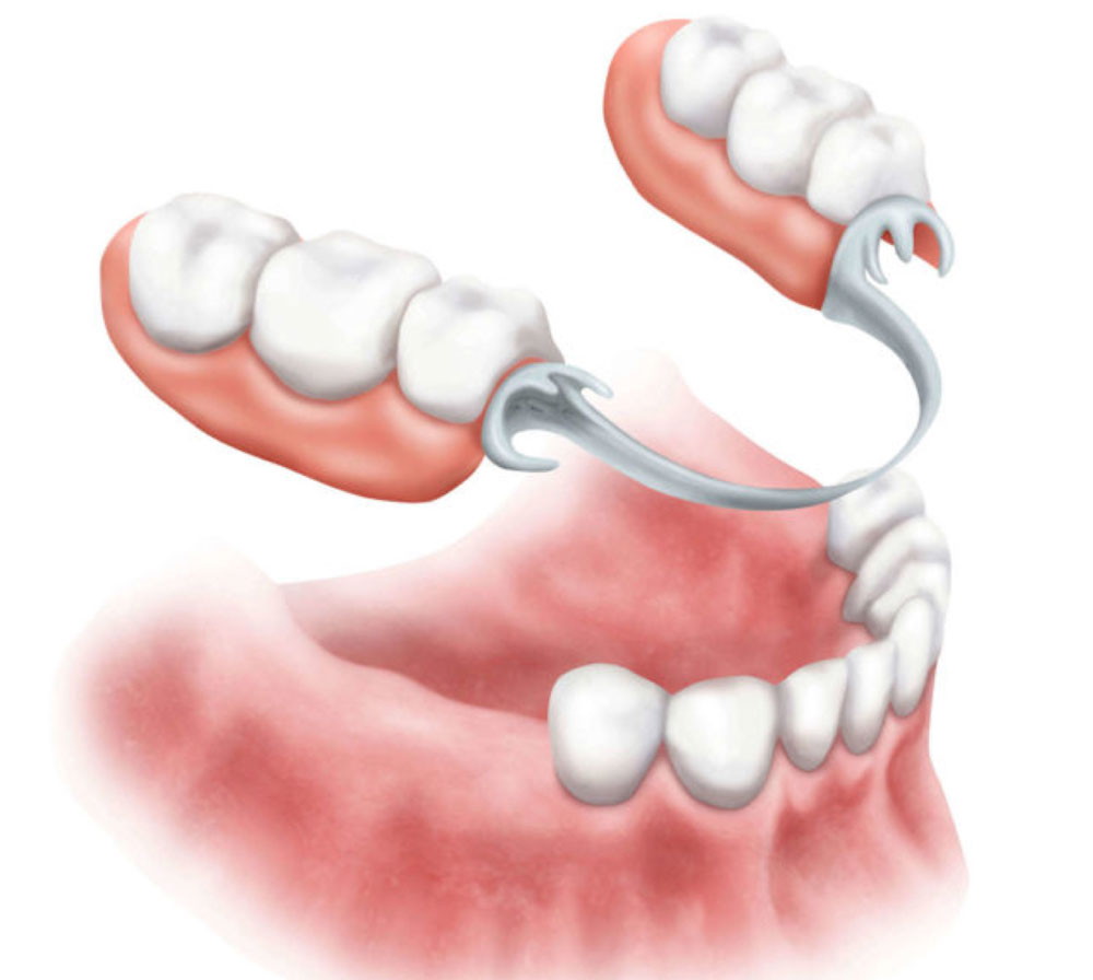 partials-advance-dental-pc-dentist-birmingham-al