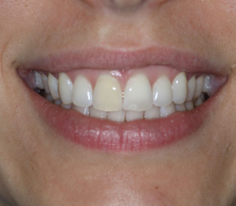 Veneers to correct front teeth discoloration (before)