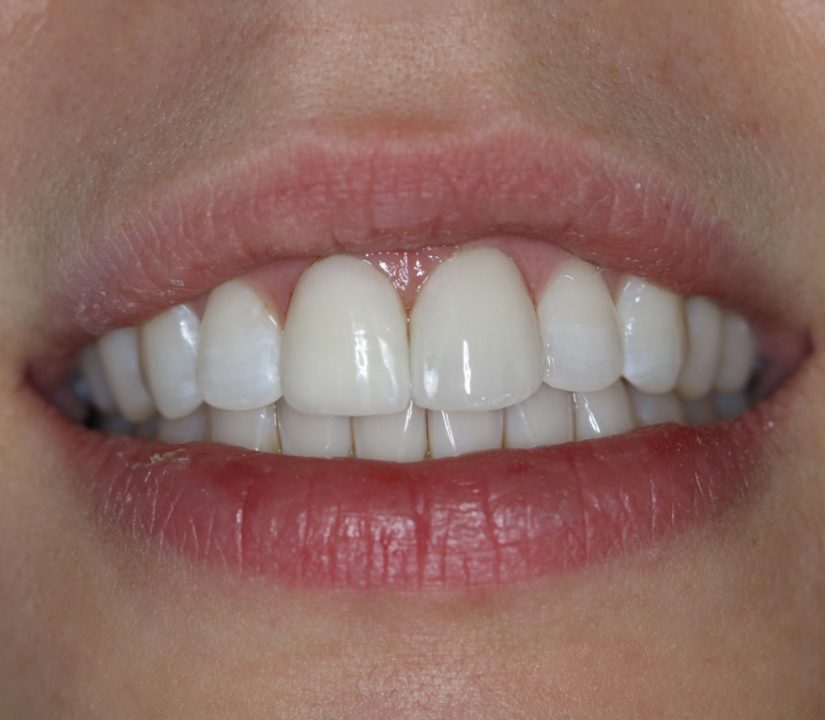 Veneers to correct discoloration of front teeth (after)