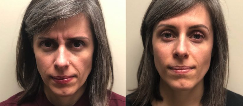 Botox glabellar before and after