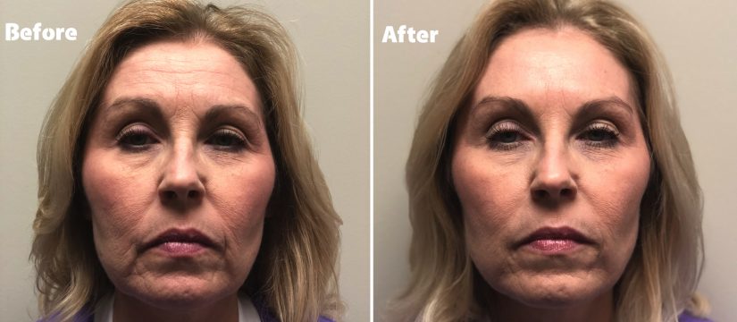 Botox and fillers before and after