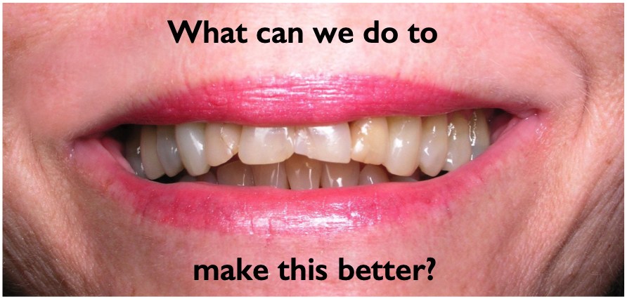 Dental Insurance That Covers Bridges The Difference