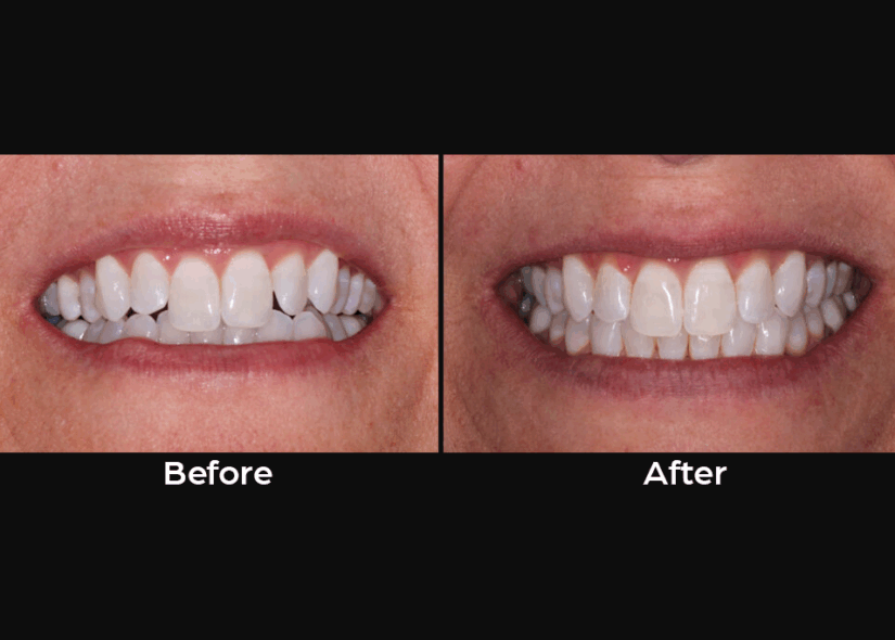 clear-aligners-before-after
